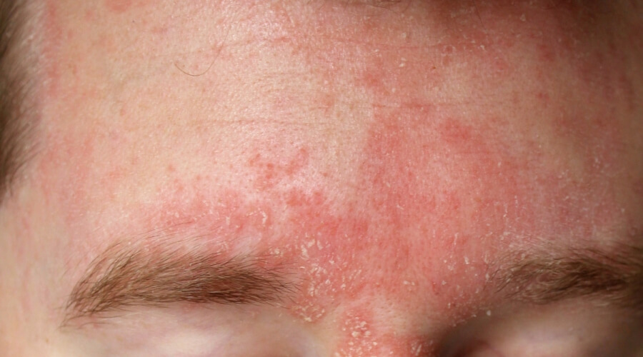 علاج حساسية الجلد